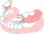 入れ歯（義歯）の画像