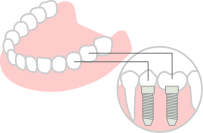 インプラントの画像