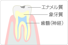 軽度のむし歯