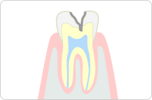 中度のむし歯