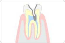 重度のむし歯