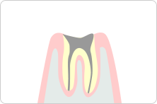 最重度のむし歯