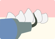 歯石・歯垢の除去