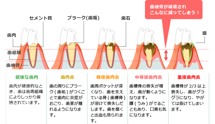 歯周病の症状と進行の様子