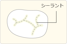 シーラントで奥歯のむし歯を予防！